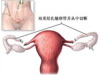 女性结扎