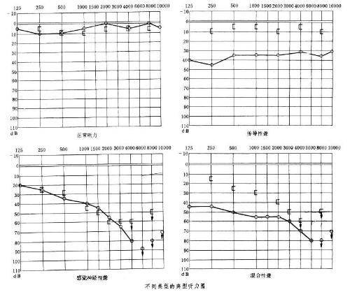 听力测试法