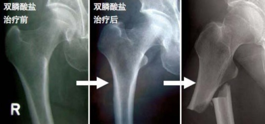 双膦酸盐
