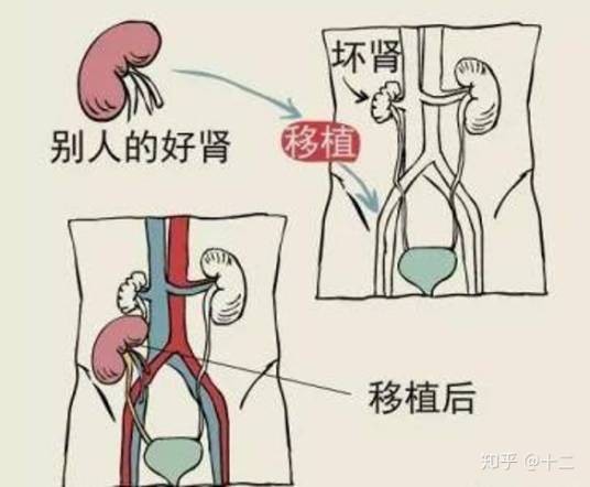 肾移植