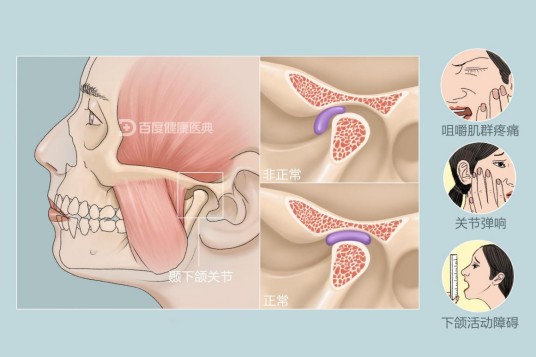 颞下颌关节紊乱综合征