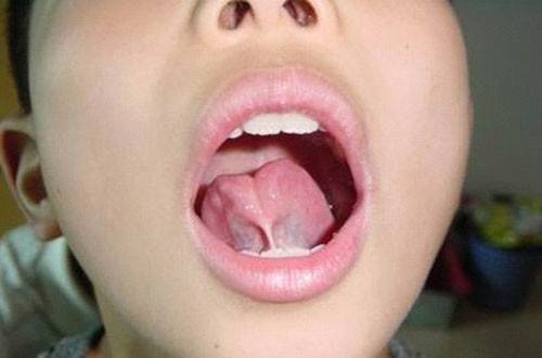 舌系带