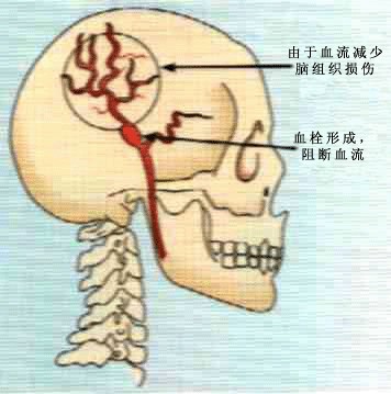 脑供血不足