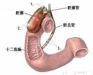 胆囊切除术