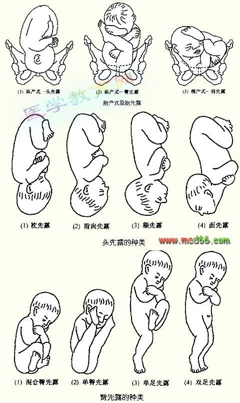胎位图
