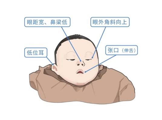 小儿唐氏综合征