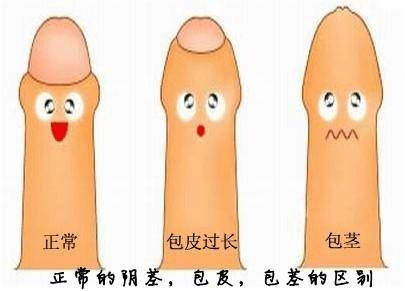 包皮垢