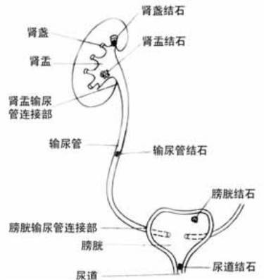 泌尿系统结石