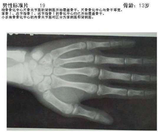 骨龄