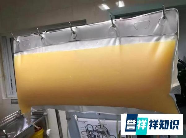 男子体检血中抽出2升油浆