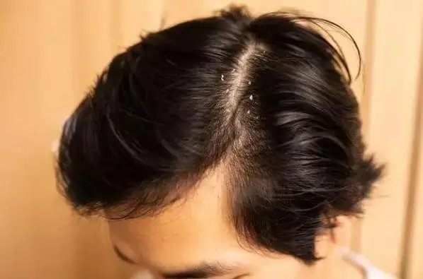 男子坚持半年不用洗发水,竟从秃顶变满头黑发?当事人是如何回应此事的?