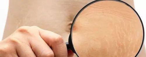妊娠纹镜头该被剪掉吗？或许这才是怀孕后的人间真实！