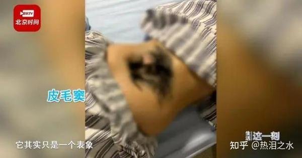 女孩染怪病后腰长出浓密毛发 这是咋情况？