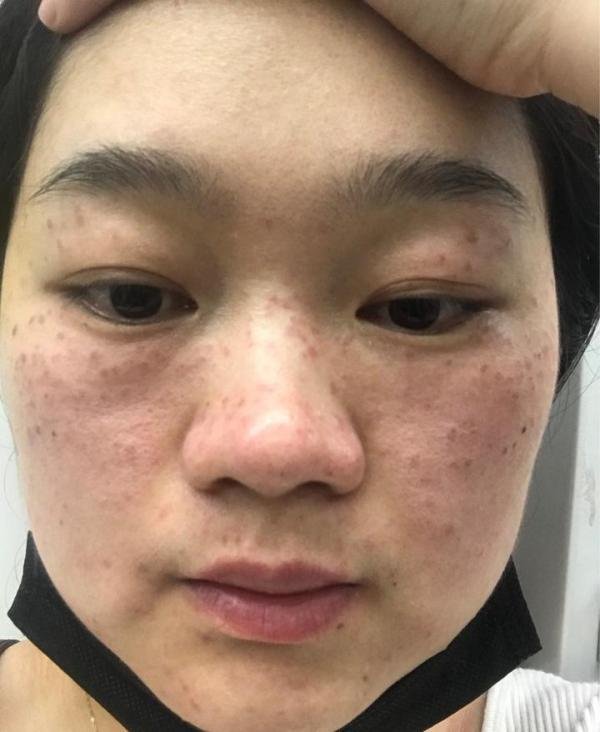 深圳北大的激光祛斑经历........