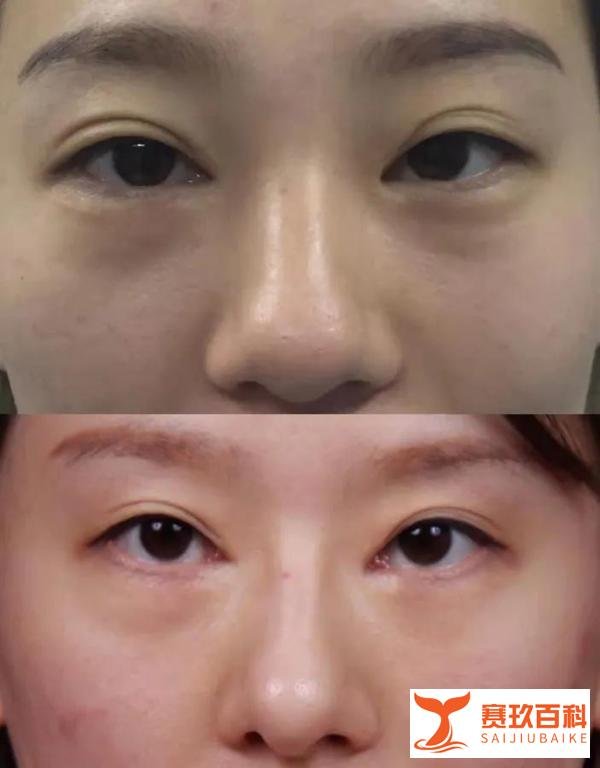 草稿女孩整容反变丑 整容风险有多大与郑州孕妇怀上八胞胎是一样事