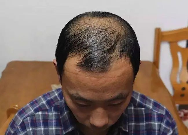 男子坚持半年不用洗发水,竟从秃顶变满头黑发?当事人是如何回应此事的?