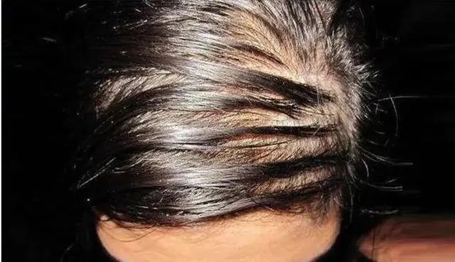 男子坚持半年不用洗发水,竟从秃顶变满头黑发?当事人是如何回应此事的?