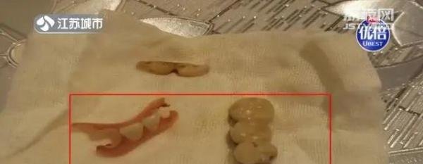 老人术后体内发现5颗牙和牙套 给老人带来致命性伤害