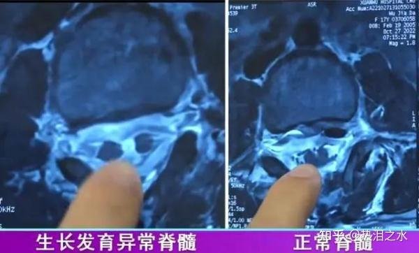 女孩染怪病后腰长出浓密毛发 这是咋情况？