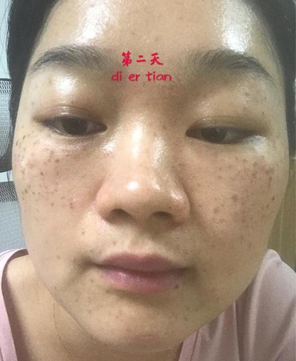 深圳北大的激光祛斑经历........